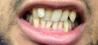 Before and After Invisalign Treatment Kingston