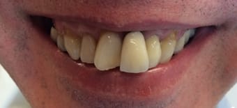 Before and After Invisalign Treatment Kingston