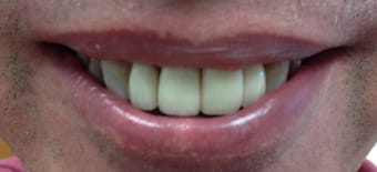 Before and After Invisalign Treatment Kingston