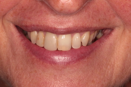 Before and After Invisalign Treatment Kingston