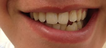 Before and After Invisalign Treatment Kingston