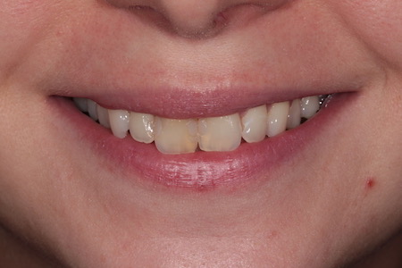 Before and After Invisalign Treatment Kingston