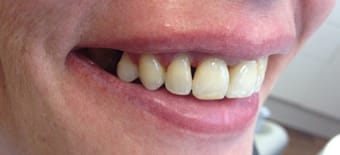 Before and After Invisalign Treatment Kingston