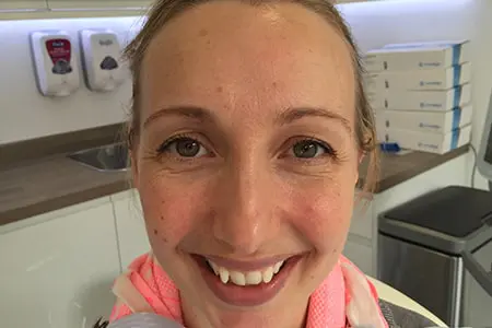 Before and After Invisalign Treatment Kingston Before and After Invisalign Treatment Kingston