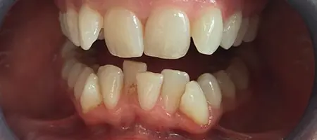 Before and After Invisalign Treatment Kingston Before and After Invisalign Treatment Kingston