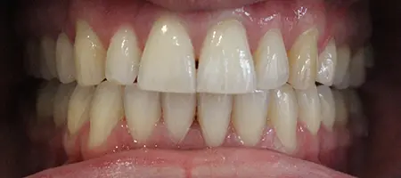 Before and After Invisalign Treatment Kingston Before and After Invisalign Treatment Kingston