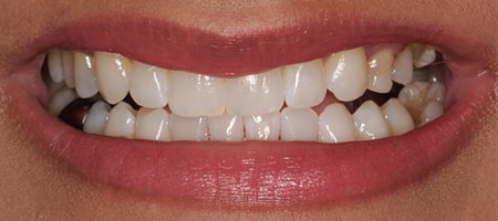 Before and After Invisalign Treatment Kingston Before and After Invisalign Treatment Kingston