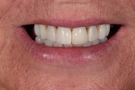 Before and After Invisalign Treatment Kingston