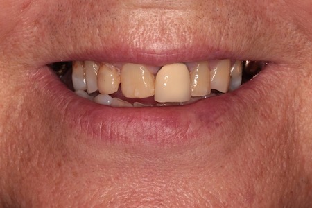 Before and After Invisalign Treatment Kingston