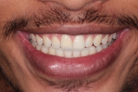 Before and After Invisalign Treatment Kingston