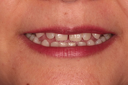 Before and After Invisalign Treatment Kingston