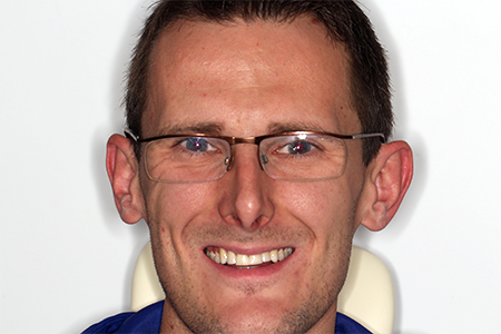 Before and After Invisalign Treatment Kingston Before and After Invisalign Treatment Kingston