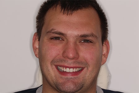 Before and After Invisalign Treatment Kingston Before and After Invisalign Treatment Kingston