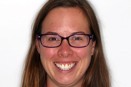Before and After Invisalign Treatment Kingston Before and After Invisalign Treatment Kingston