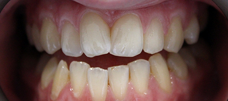 Before and After Invisalign Treatment Kingston Before and After Invisalign Treatment Kingston