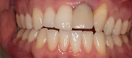 Before and After Invisalign Treatment Kingston