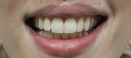 Before and After Invisalign Treatment Kingston