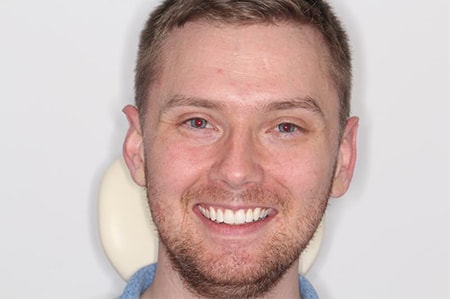 Before and After Invisalign Treatment Kingston Before and After Invisalign Treatment Kingston