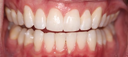 Before and After Invisalign Treatment Kingston Before and After Invisalign Treatment Kingston