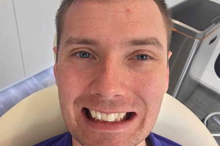 Before and After Invisalign Treatment Kingston Before and After Invisalign Treatment Kingston