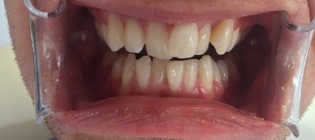 Before and After Invisalign Treatment Kingston Before and After Invisalign Treatment Kingston