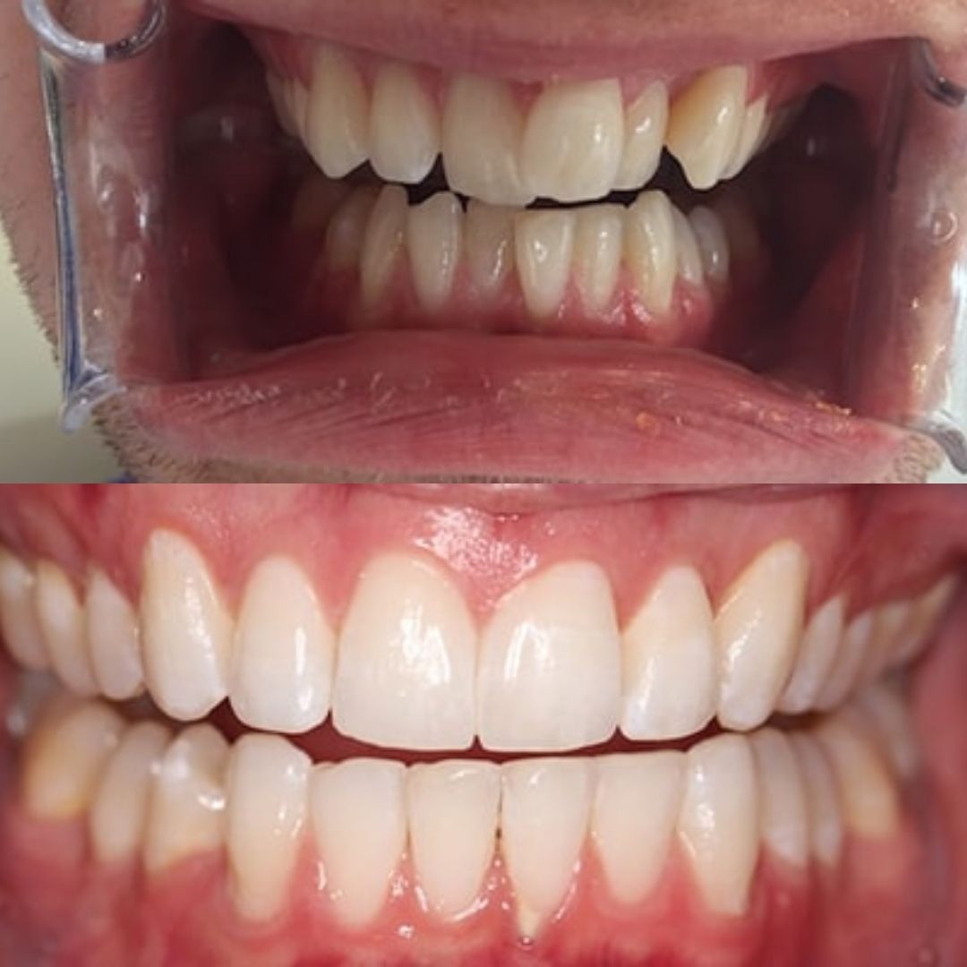 invisalign before after 3